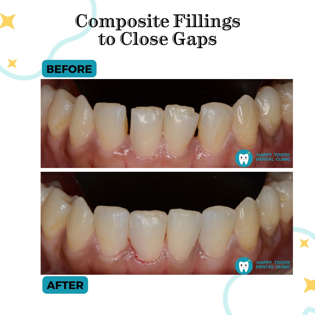 composite fillings to close gaps