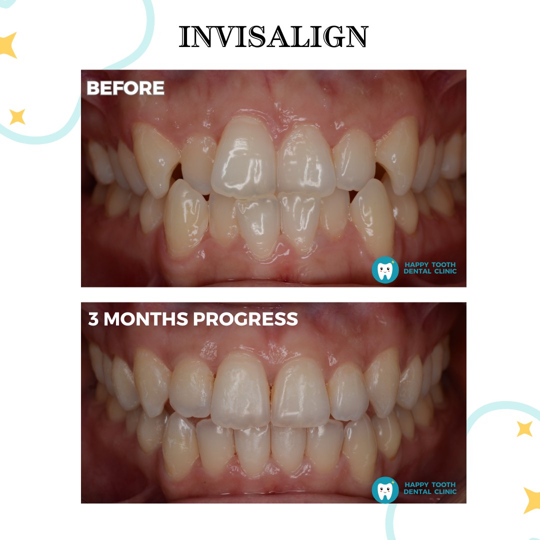 Invisalign