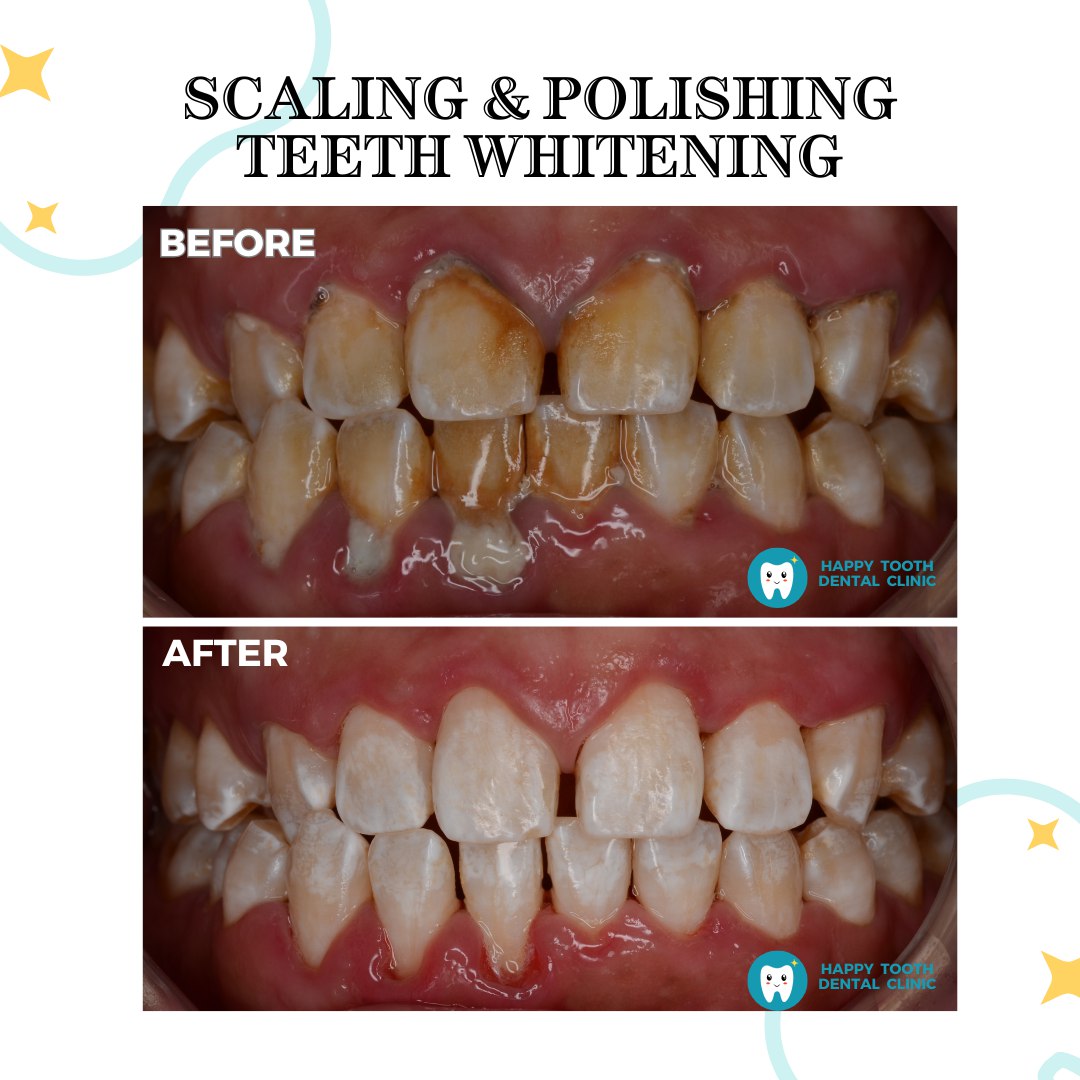 scaling, polishing, teeth whitening