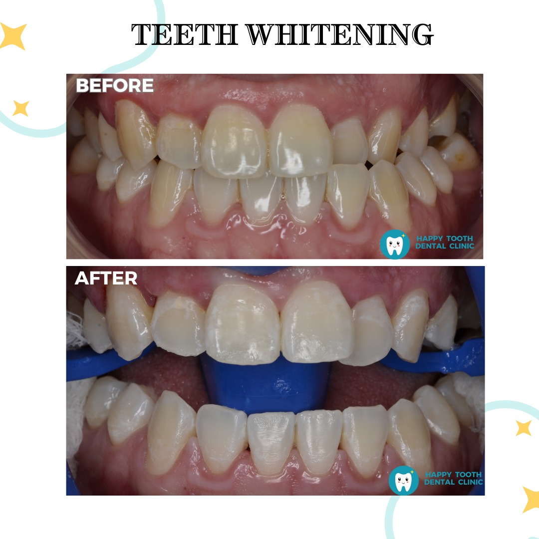 teeth whitening