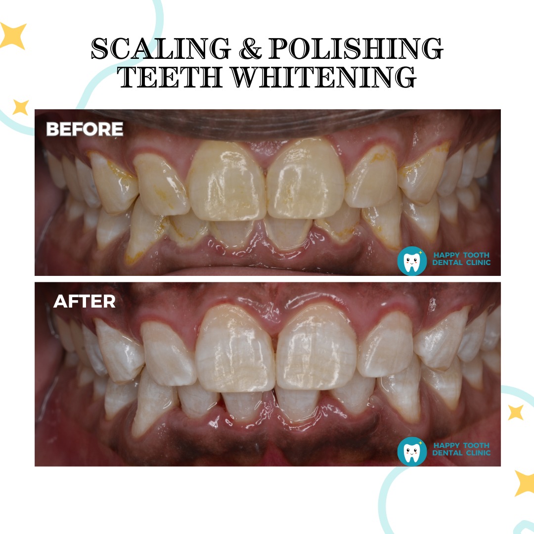 scaling & polishing and teeth whitening