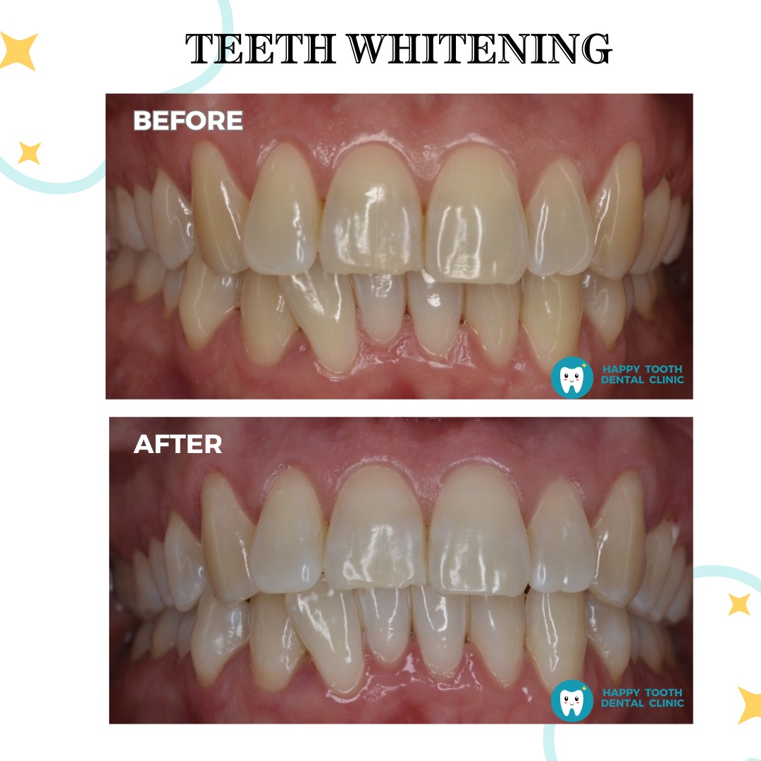 teeth whitening