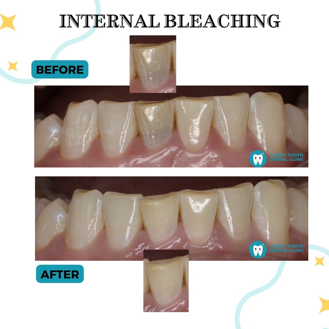 internal bleaching