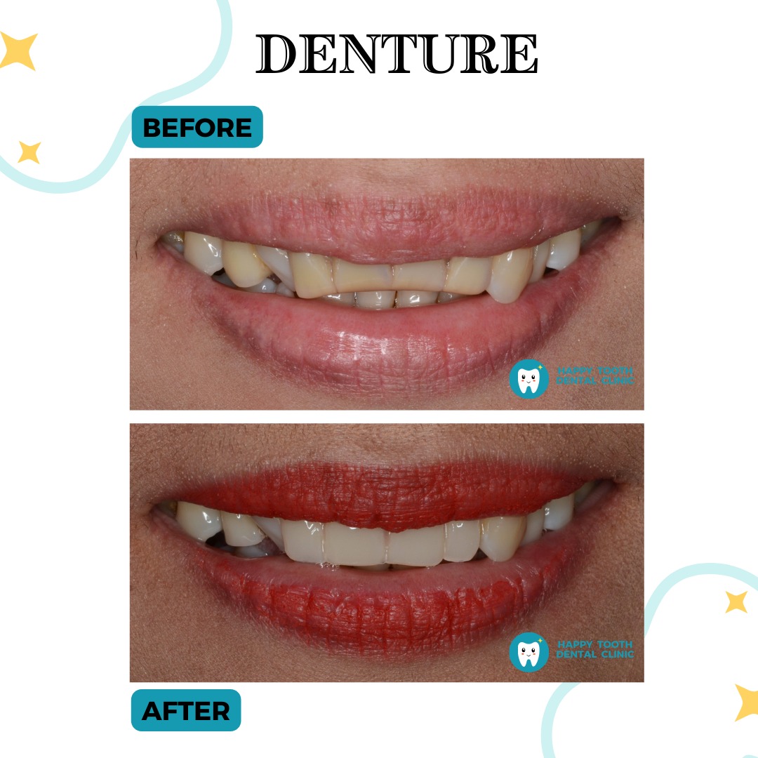 denture