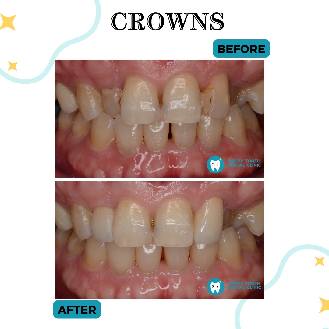 crowns