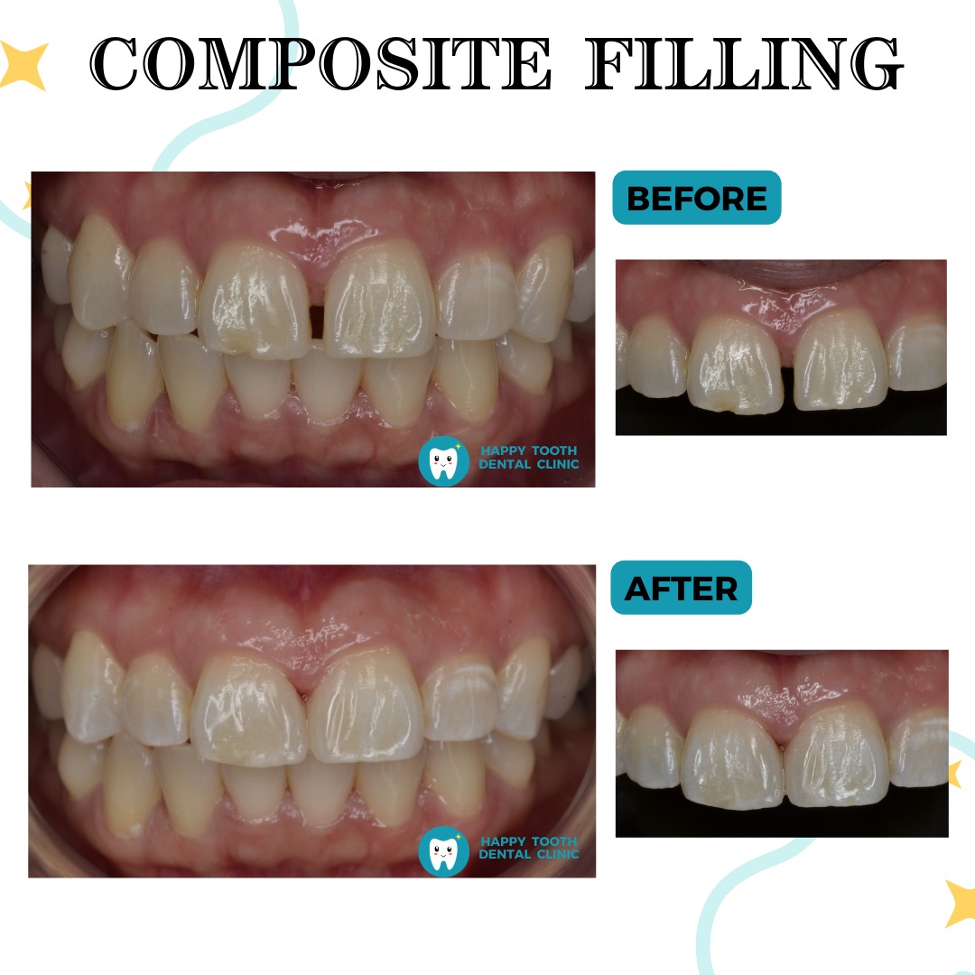 composite filling